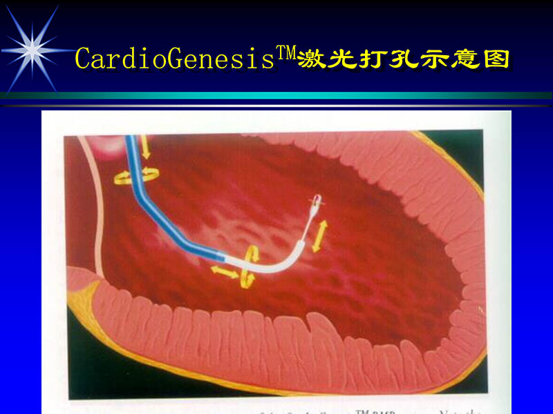 071719234773_02000-11-21激光在心脏外科的应用_17.jpg
