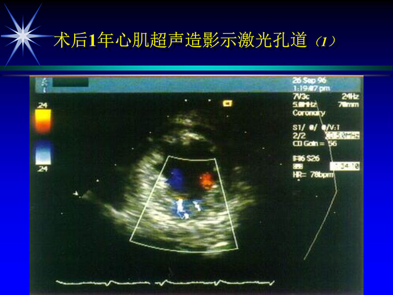 071719234773_02000-11-21激光在心脏外科的应用_46.jpg