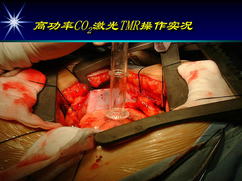 071719234773_02000-11-21激光在心脏外科的应用_66.jpg