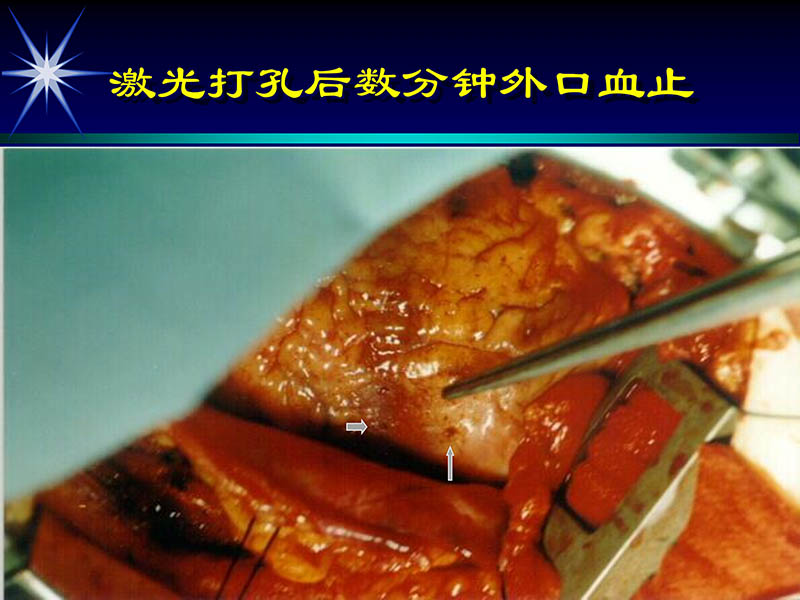 071719234773_02000-11-21激光在心脏外科的应用_68.jpg