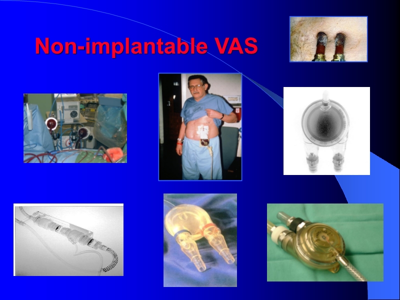 071813452002_0reatingHeartFailurewithVentricularAssistDevice_7.jpg