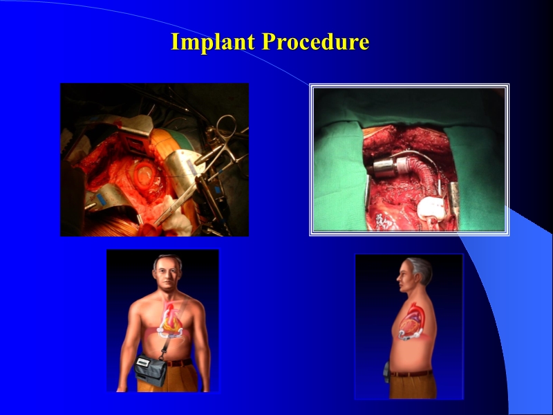 071813452002_0reatingHeartFailurewithVentricularAssistDevice_29.jpg