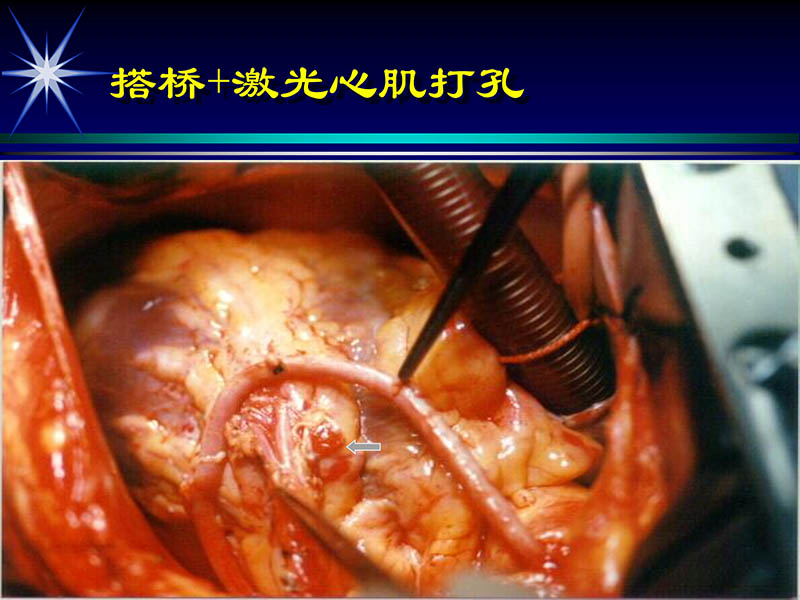 071813461818_02002-10-13激光在心血管疾病治疗中的应用_25.jpg