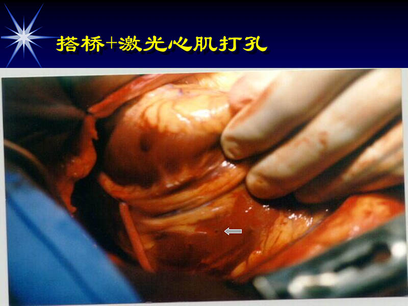 071813461818_02002-10-13激光在心血管疾病治疗中的应用_26.jpg