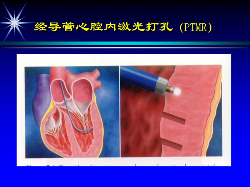 071813461818_02002-10-13激光在心血管疾病治疗中的应用_28.jpg