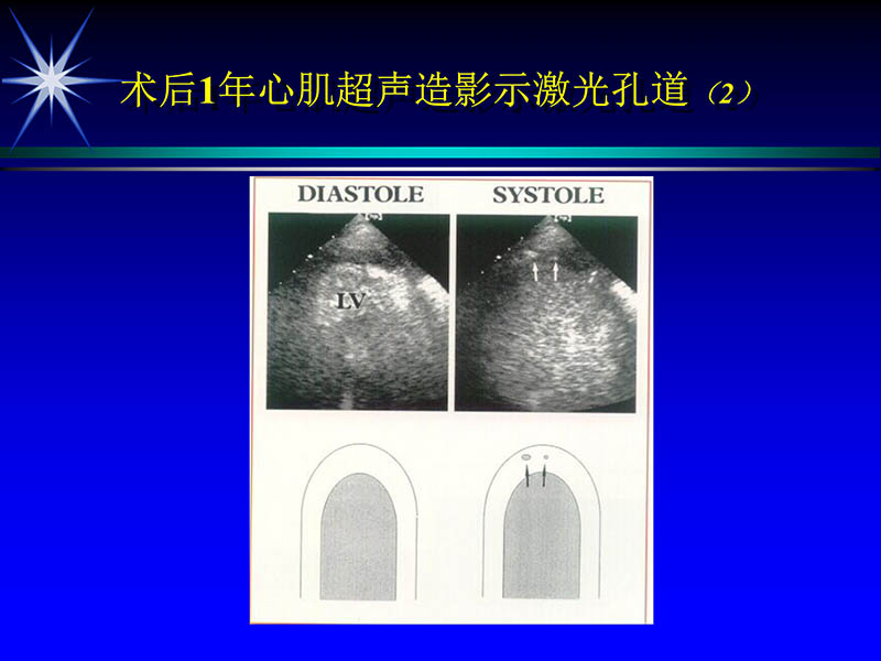071813461818_02002-10-13激光在心血管疾病治疗中的应用_49.jpg