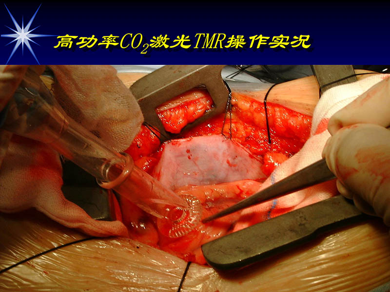 071813461818_02002-10-13激光在心血管疾病治疗中的应用_69.jpg