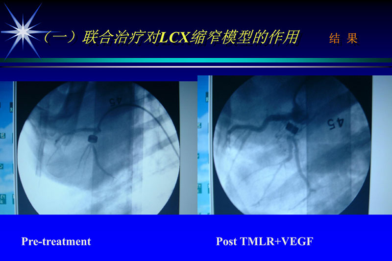 071815272322_02003-12-30vegf基因联合激光心肌血运重建的研究_32.jpg