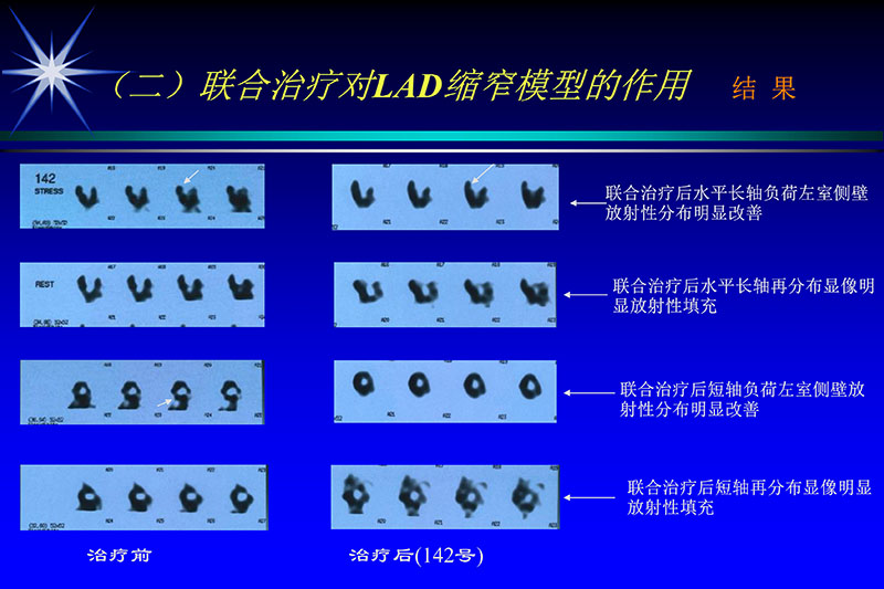 071815272322_02003-12-30vegf基因联合激光心肌血运重建的研究_44.jpg