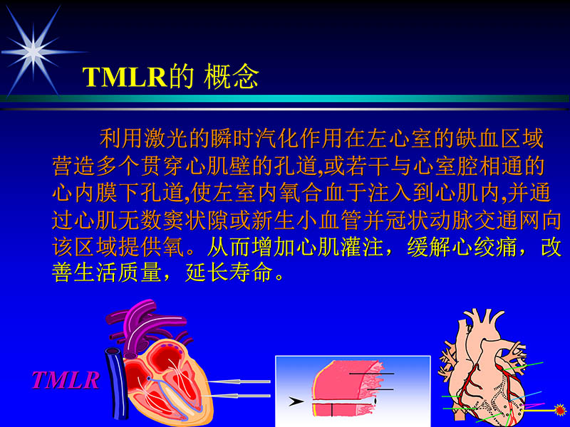071815311003_02004-06-15激光直接心肌血运重建治疗冠心病_2.jpg
