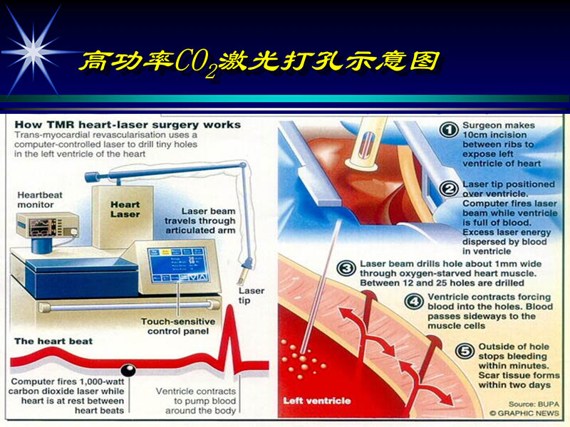 071815311003_02004-06-15激光直接心肌血运重建治疗冠心病_6.jpg