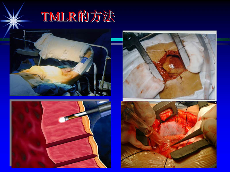 071815311003_02004-06-15激光直接心肌血运重建治疗冠心病_11.jpg