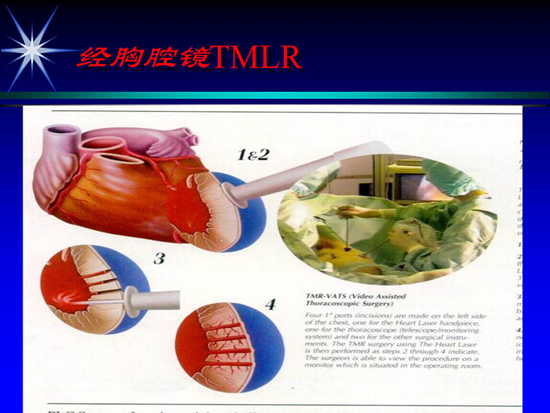 071815311003_02004-06-15激光直接心肌血运重建治疗冠心病_15.jpg