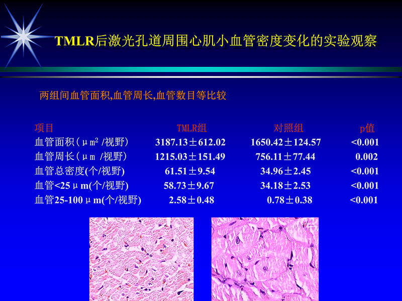 071815311003_02004-06-15激光直接心肌血运重建治疗冠心病_58.jpg