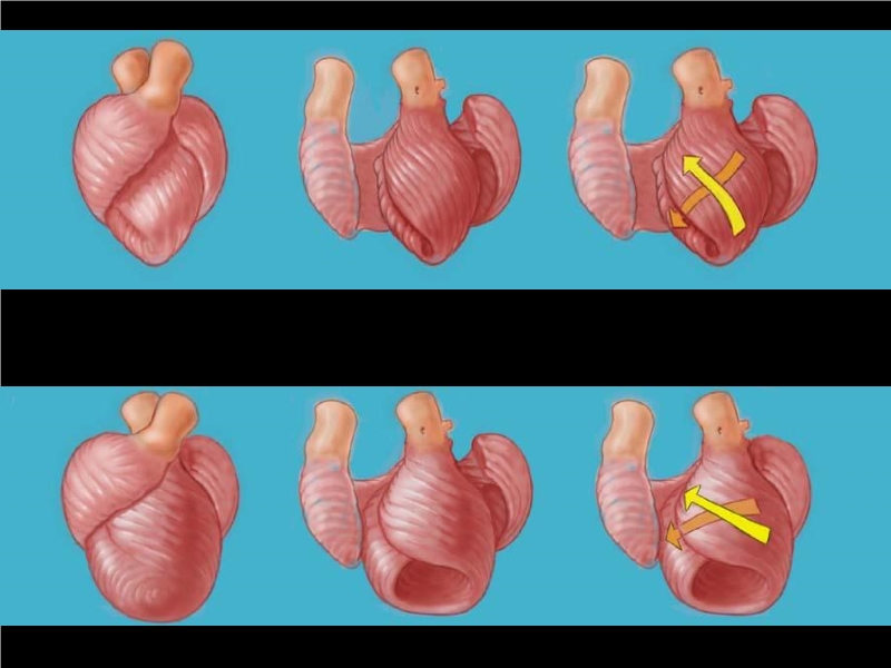 071816214728_0urrentSurgeryApproachestoEnd-stageHeartFailure_15.jpg