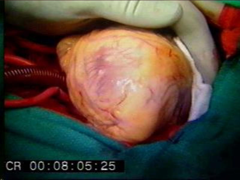 071816214728_0urrentSurgeryApproachestoEnd-stageHeartFailure_21.jpg