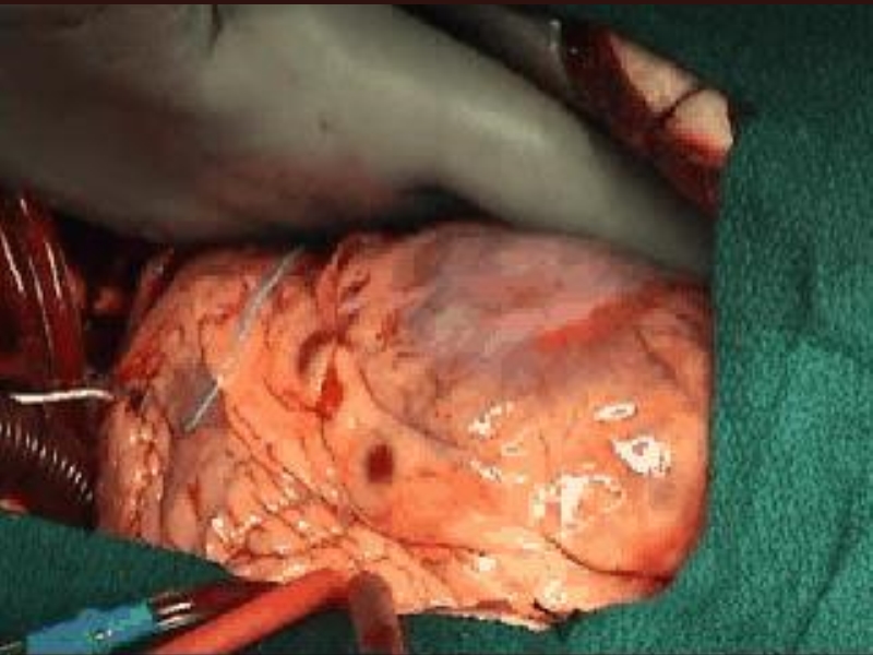071816214728_0urrentSurgeryApproachestoEnd-stageHeartFailure_22.jpg