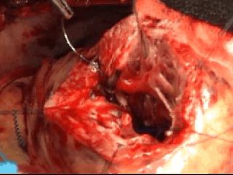071816214728_0urrentSurgeryApproachestoEnd-stageHeartFailure_23.jpg