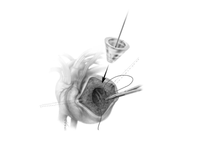 071816214728_0urrentSurgeryApproachestoEnd-stageHeartFailure_26.jpg