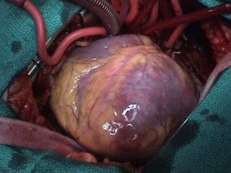 071816214728_0urrentSurgeryApproachestoEnd-stageHeartFailure_29.jpg