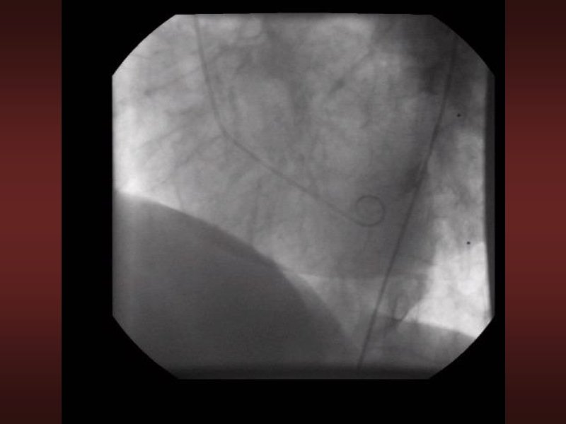 071816214728_0urrentSurgeryApproachestoEnd-stageHeartFailure_30.jpg