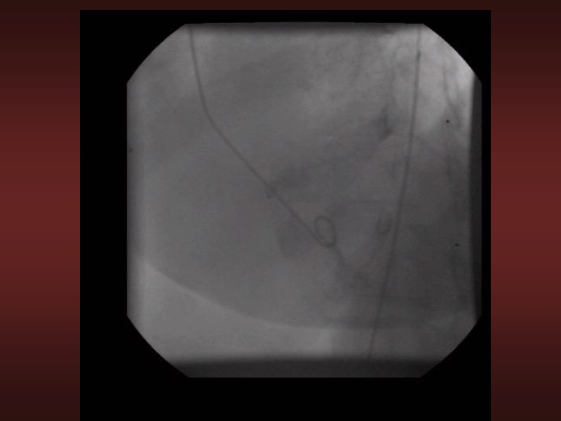 071816214728_0urrentSurgeryApproachestoEnd-stageHeartFailure_31.jpg