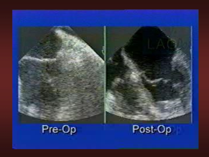 071816214728_0urrentSurgeryApproachestoEnd-stageHeartFailure_32.jpg