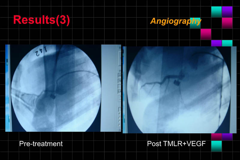071816283803_0ONOFTMLRANDVEGFGENETHERAPYISCHEMICPORCINEHEART_11.jpg