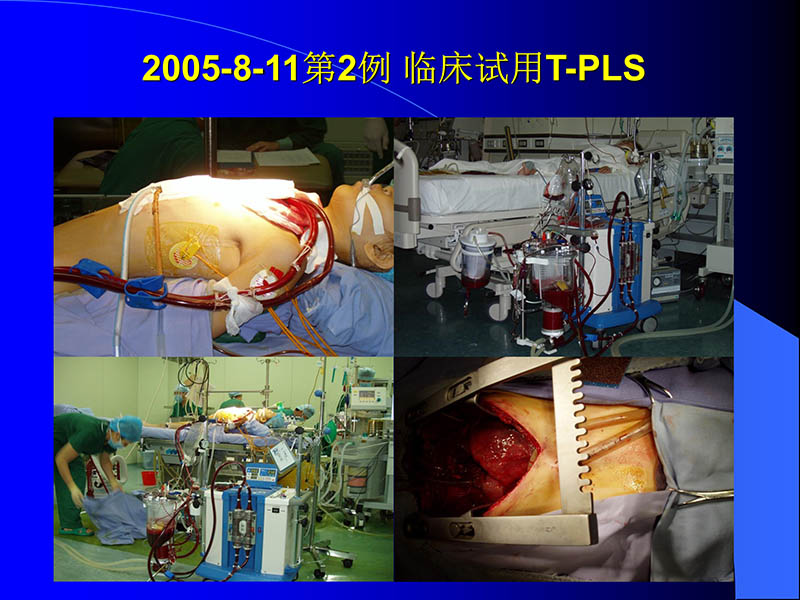 071816413472_02005-08-18现代人工心室装置治疗心衰临床应用_77.jpg