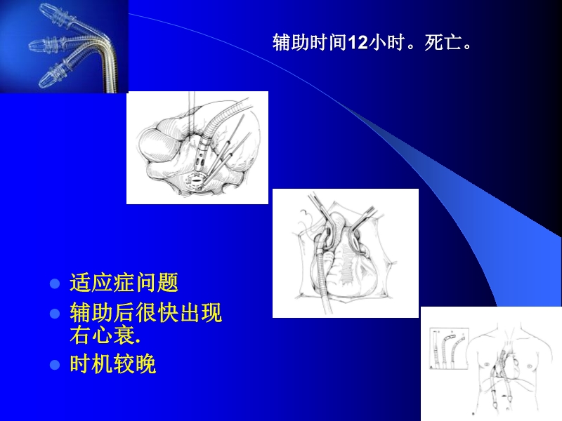 072010433259_02005-12-10机械辅助循环治疗围手术期心衰的临床体会_9.jpg