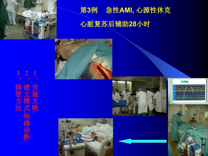 072010433259_02005-12-10机械辅助循环治疗围手术期心衰的临床体会_11.jpg