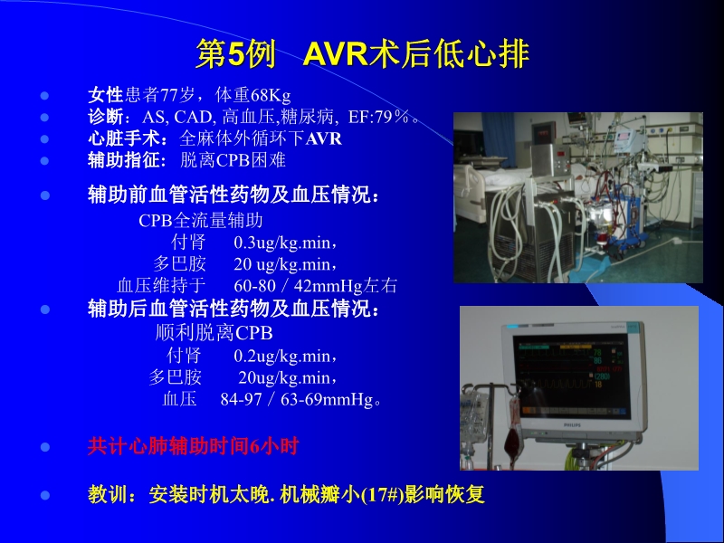 072010433259_02005-12-10机械辅助循环治疗围手术期心衰的临床体会_15.jpg