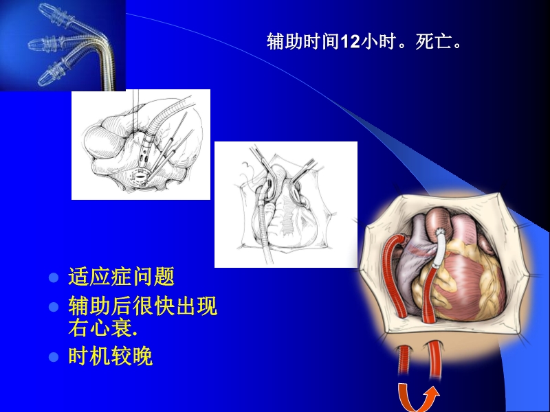 072011010455_02006-11-17应用T-PLS治疗围手术期心衰的临床体会_4.jpg