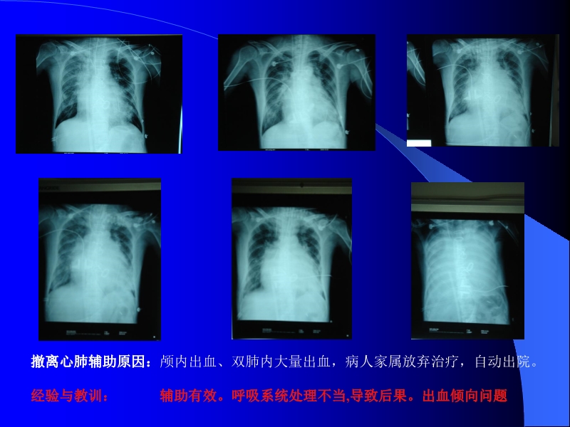 072011010455_02006-11-17应用T-PLS治疗围手术期心衰的临床体会_9.jpg