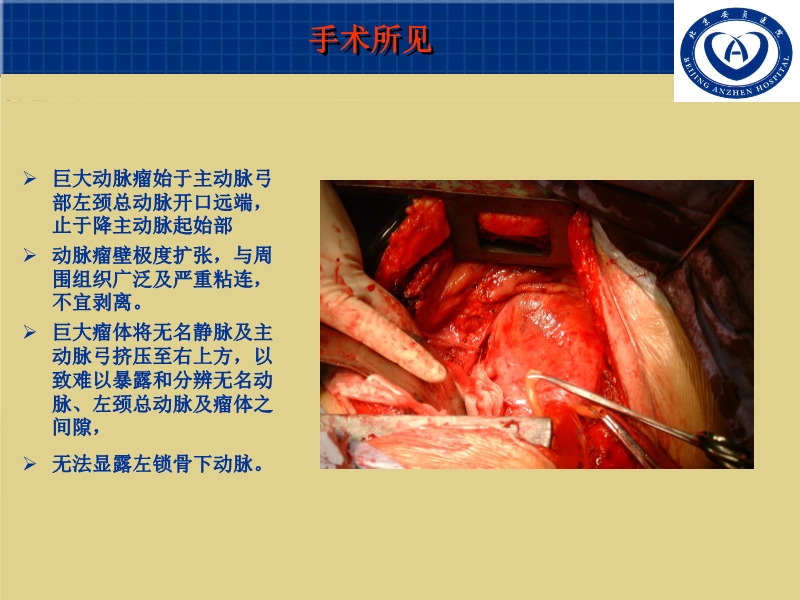 072011055676_02007-03-15巨大主动脉弓降部动脉瘤外科治疗(个例体会)_3.jpg