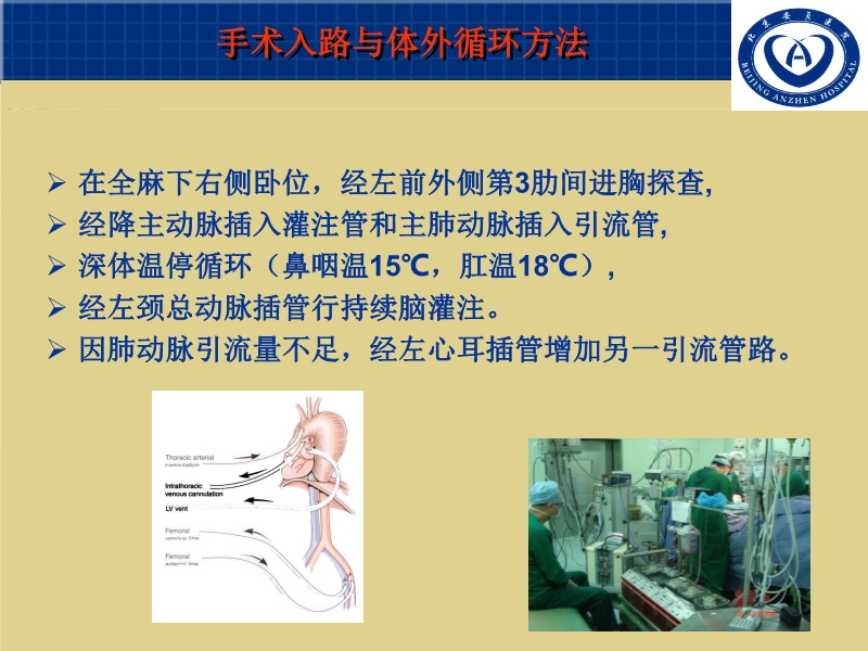 072011055676_02007-03-15巨大主动脉弓降部动脉瘤外科治疗(个例体会)_4.jpg