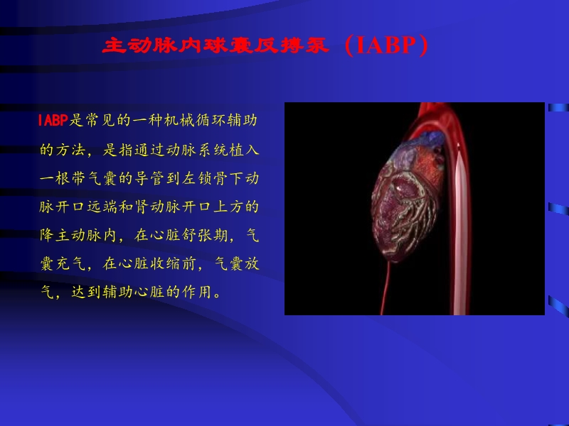 072812090405_02010-06-17现代机械辅助循环治疗心力衰竭_4.jpg