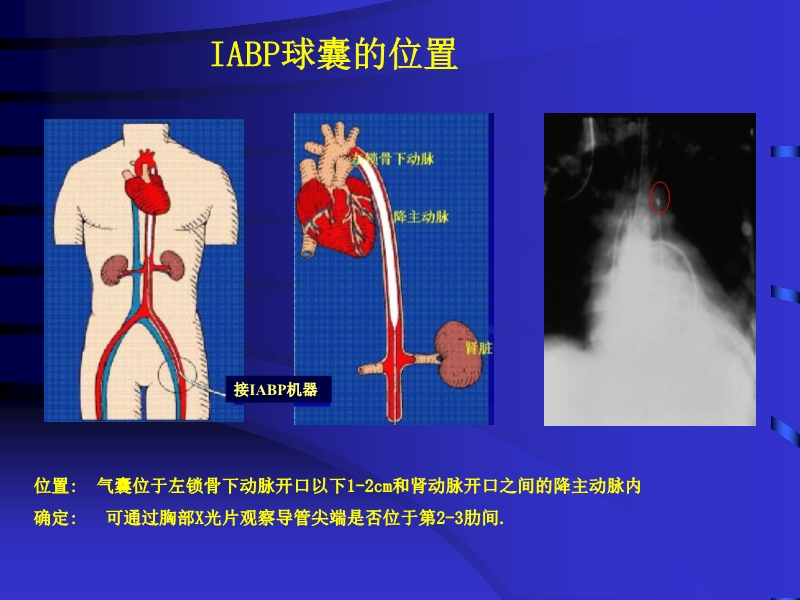 072812090405_02010-06-17现代机械辅助循环治疗心力衰竭_9.jpg