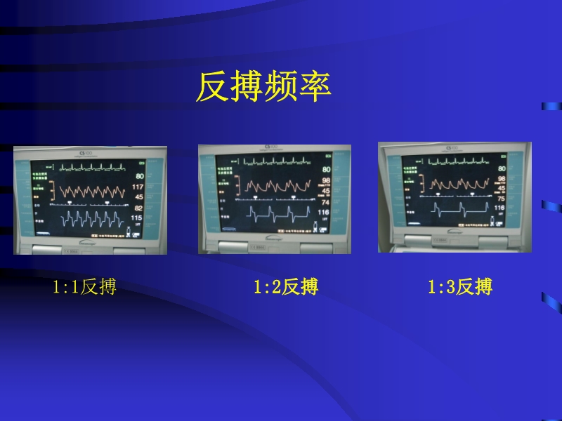 072812090405_02010-06-17现代机械辅助循环治疗心力衰竭_17.jpg