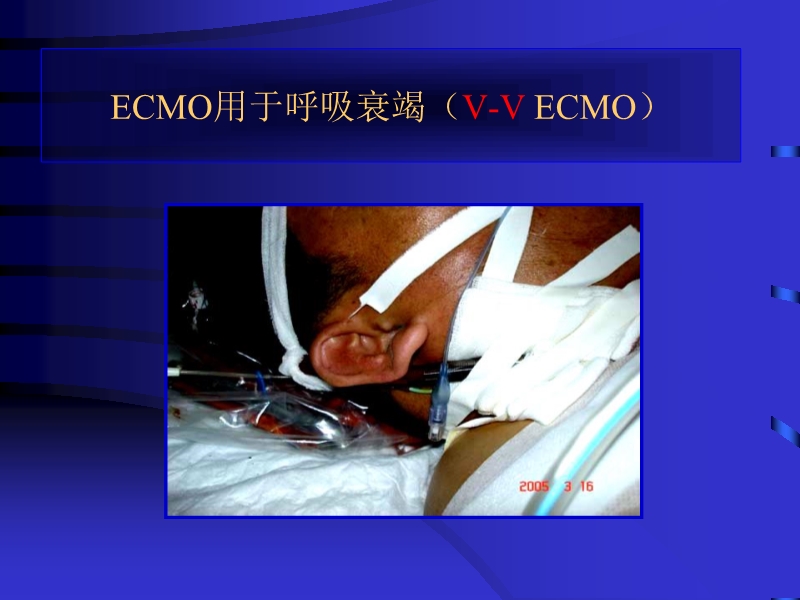 072812090405_02010-06-17现代机械辅助循环治疗心力衰竭_42.jpg