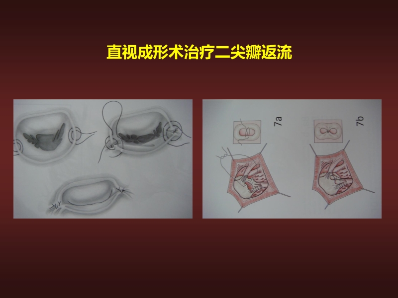 072812134128_02010-06-17心力衰竭的外科治疗_6.jpg