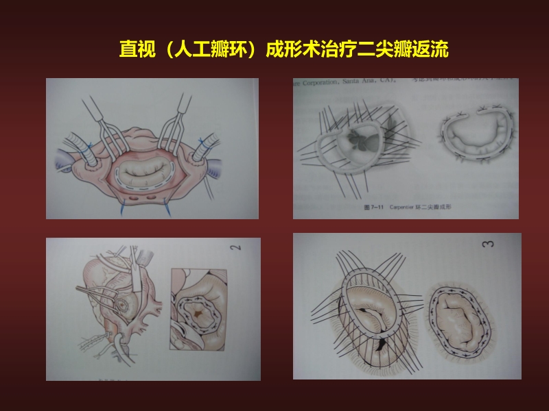 072812134128_02010-06-17心力衰竭的外科治疗_7.jpg