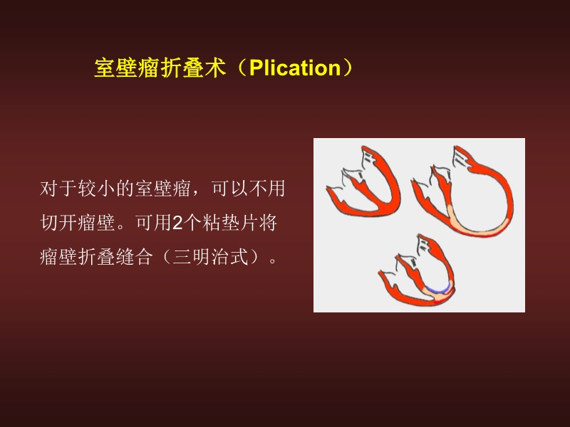 072812134128_02010-06-17心力衰竭的外科治疗_9.jpg
