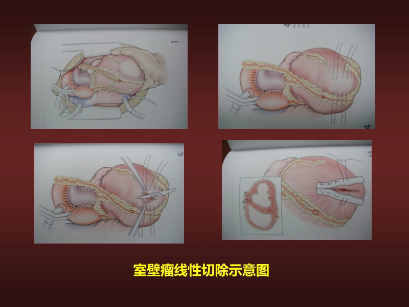 072812134128_02010-06-17心力衰竭的外科治疗_11.jpg