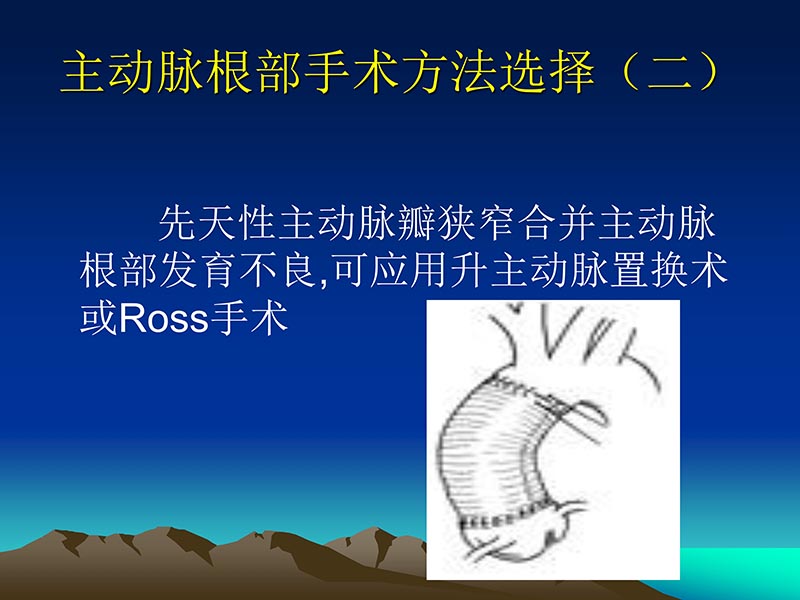 072812565383_02011-12-05心脏瓣膜外科的发展与现状_30.jpg
