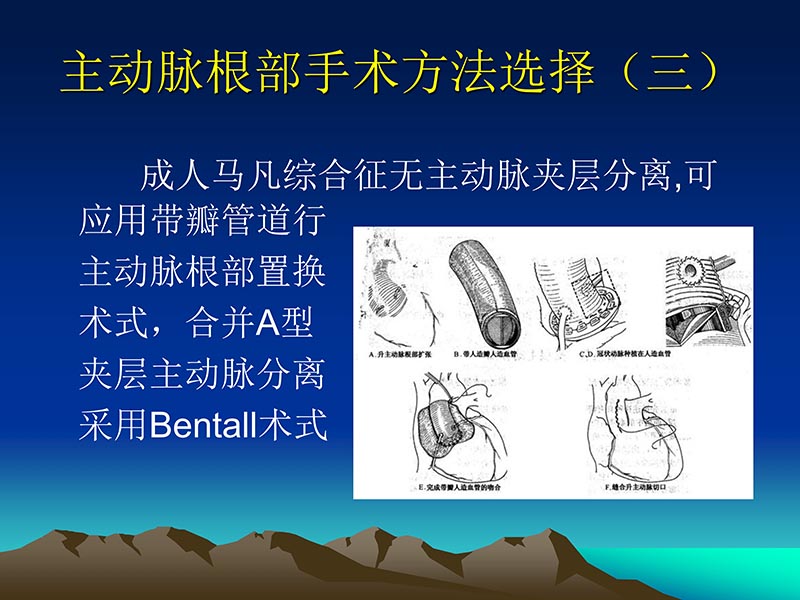 072812565383_02011-12-05心脏瓣膜外科的发展与现状_31.jpg