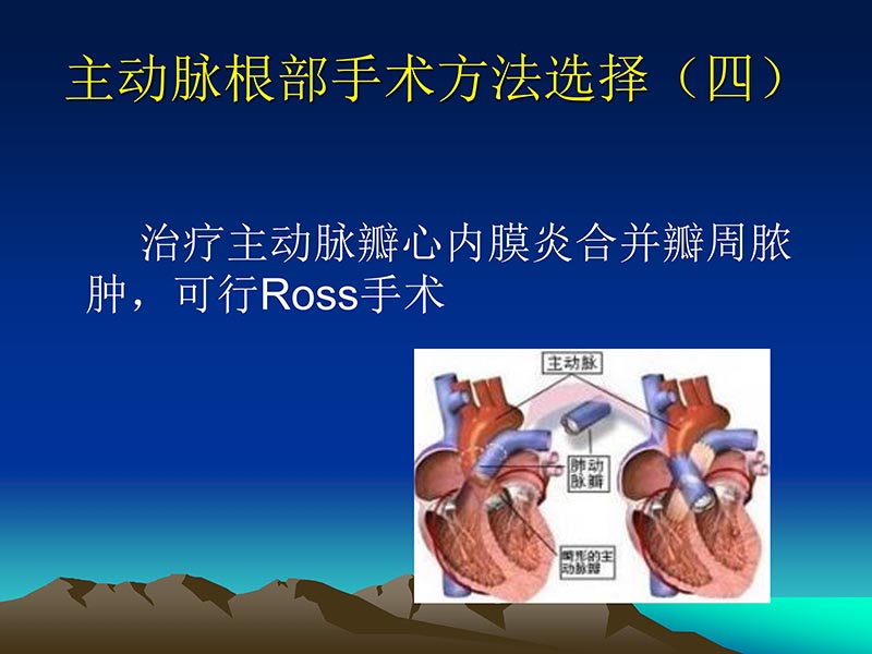 072812565383_02011-12-05心脏瓣膜外科的发展与现状_32.jpg