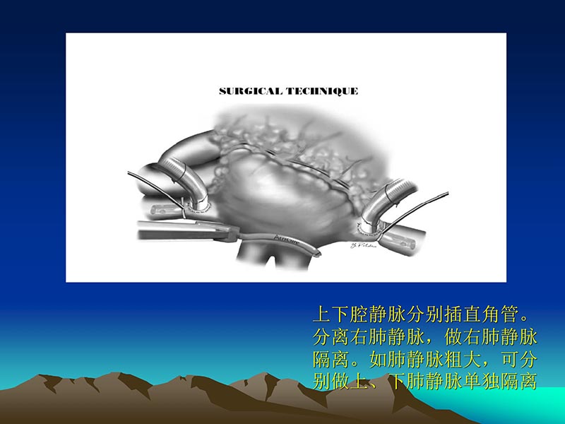 072812565383_02011-12-05心脏瓣膜外科的发展与现状_65.jpg