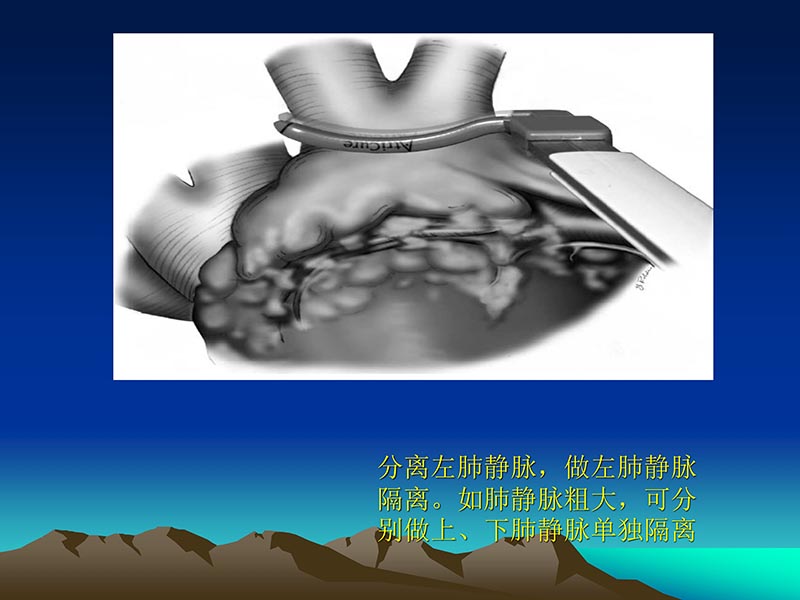 072812565383_02011-12-05心脏瓣膜外科的发展与现状_66.jpg