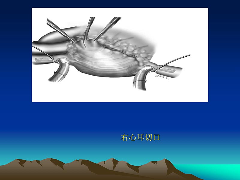 072812565383_02011-12-05心脏瓣膜外科的发展与现状_70.jpg
